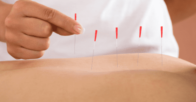 Acupuncture vs. Dry needling image