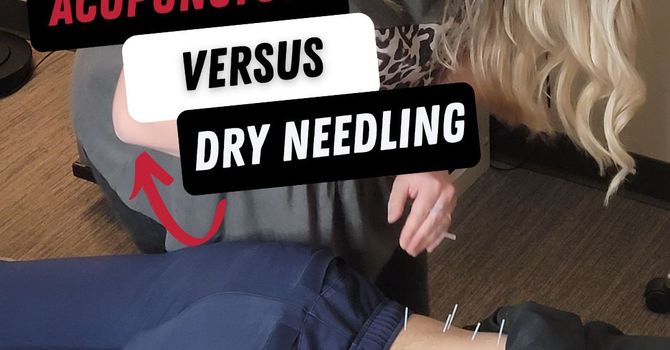 Acupuncture Versus Dry Needling image